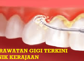 Caj Rawatan Gigi Klinik Kerajaan Naik